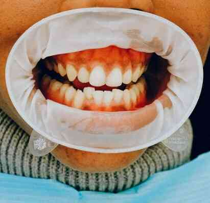 Dental Implant